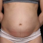 Tummy Tuck Before & After Patient #33574