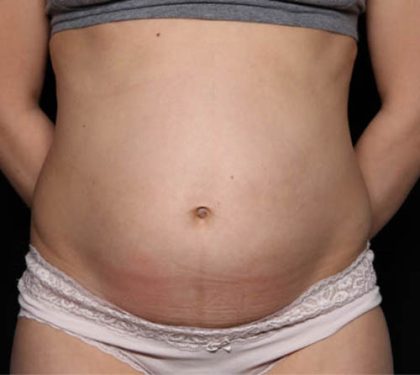 Tummy Tuck Before & After Patient #33574