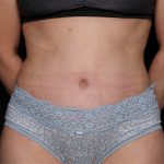 Tummy Tuck Before & After Patient #33574