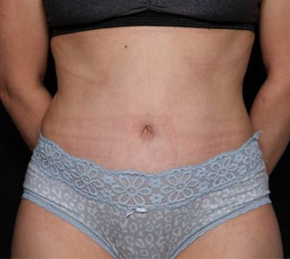 Tummy Tuck Before & After Patient #33574