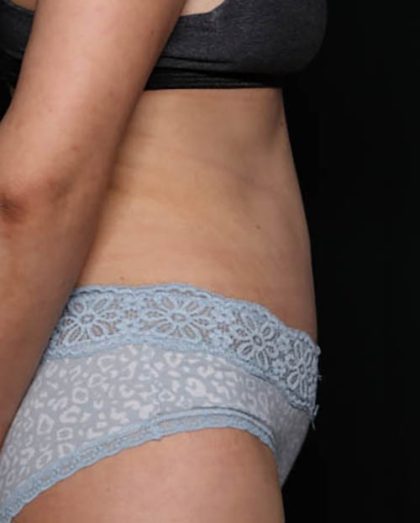 Tummy Tuck Before & After Patient #33574