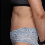 Tummy Tuck Before & After Patient #33574