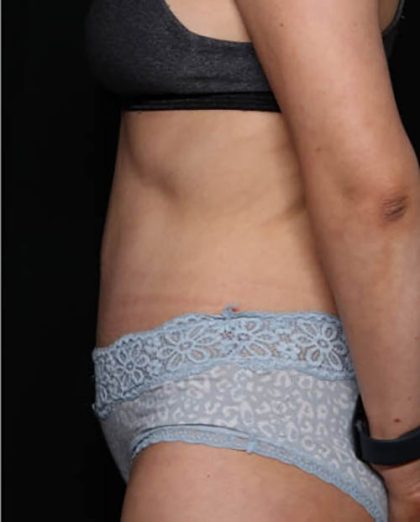 Tummy Tuck Before & After Patient #33574
