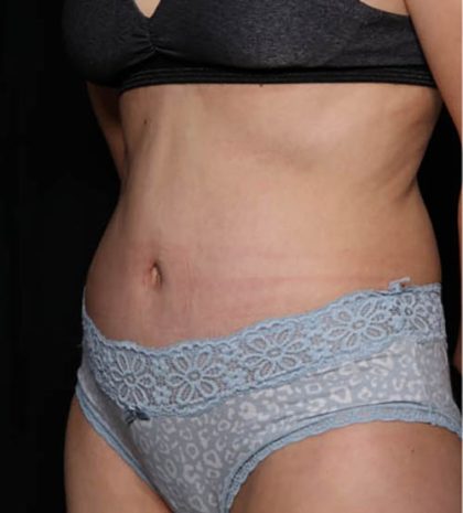 Tummy Tuck Before & After Patient #33574