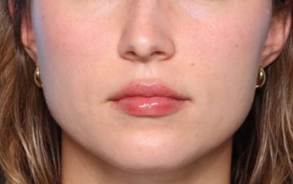 Lip Filler Before & After Patient #33546