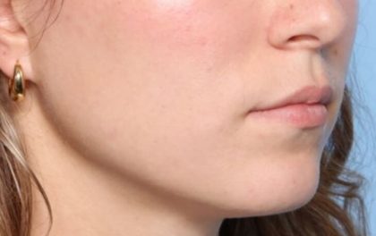 Lip Filler Before & After Patient #33546