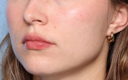 Lip Filler Before & After Patient #33546