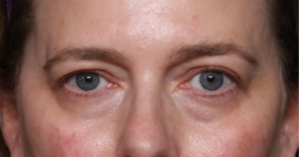 Lower Blepharoplasty Before & After Patient #33660