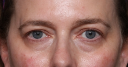 Brow Lift Before & After Patient #33660