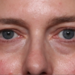 Blepharoplasty and Brow Lift Before & After Patient #34569
