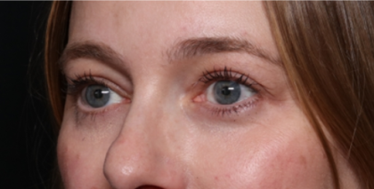 Lower Blepharoplasty Before & After Patient #33660