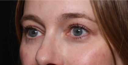 Brow Lift Before & After Patient #33660