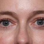 Brow Lift Before & After Patient #33660