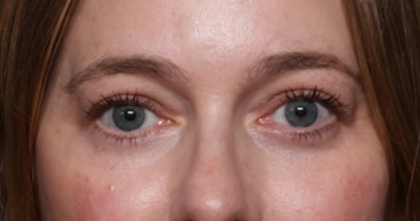 Lower Blepharoplasty Before & After Patient #33660