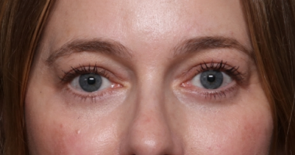 Brow Lift Before & After Patient #33660