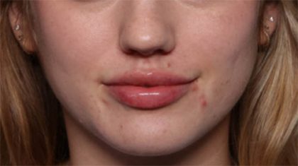 Lip Filler Before & After Patient #33629