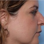 Rhinoplasty Before & After Patient #33638