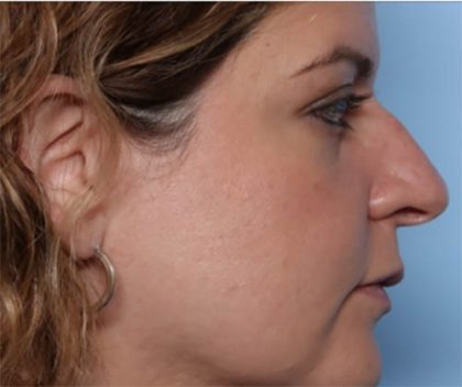 Rhinoplasty Before & After Patient #33638