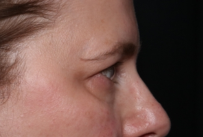 Lower Blepharoplasty Before & After Patient #33660