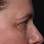 Blepharoplasty and Brow Lift Before & After Patient #34569