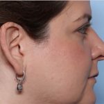 Rhinoplasty Before & After Patient #33638