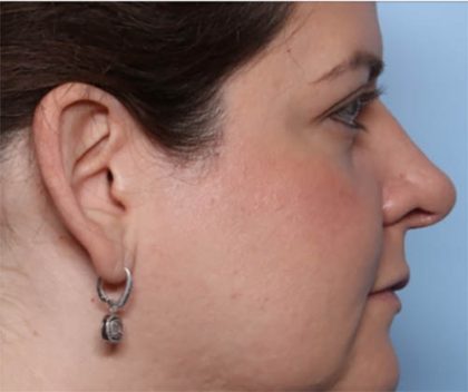 Rhinoplasty Before & After Patient #33638