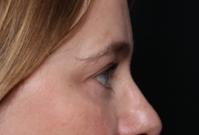 Lower Blepharoplasty Before & After Patient #33660