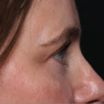 Blepharoplasty and Brow Lift Before & After Patient #34569