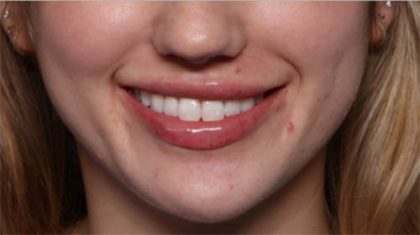 Lip Filler Before & After Patient #33629