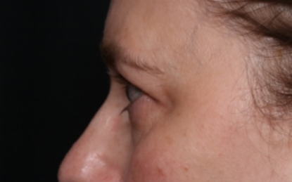 Brow Lift Before & After Patient #33660