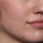 Lip Filler Before & After Patient #33629