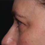Blepharoplasty and Brow Lift Before & After Patient #34569