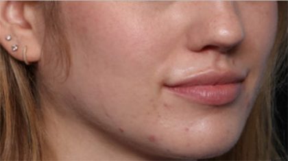 Lip Filler Before & After Patient #33629