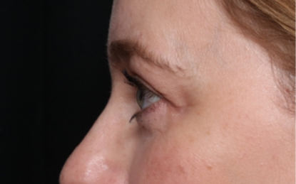 Lower Blepharoplasty Before & After Patient #33660