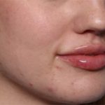 Lip Filler Before & After Patient #33629