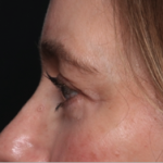 Blepharoplasty and Brow Lift Before & After Patient #34569