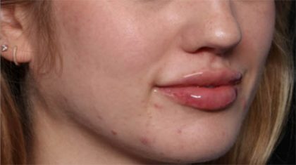 Lip Filler Before & After Patient #33629