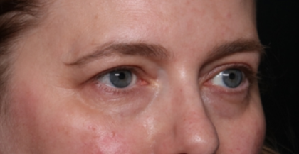 Lower Blepharoplasty Before & After Patient #33660