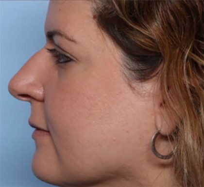 Rhinoplasty Before & After Patient #33638
