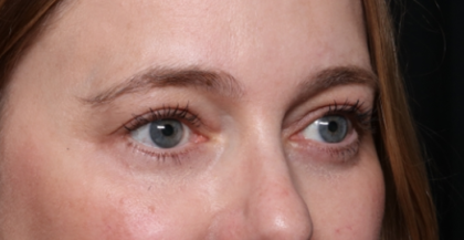 Lower Blepharoplasty Before & After Patient #33660