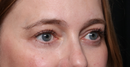 Brow Lift Before & After Patient #33660