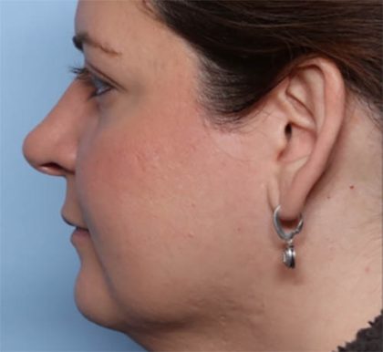 Rhinoplasty Before & After Patient #33638