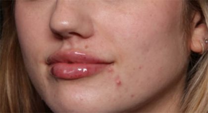 Lip Filler Before & After Patient #33629