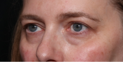 Lower Blepharoplasty Before & After Patient #33660