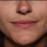 Lip Filler Before & After Patient #33685