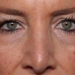 Blepharoplasty Before & After Patient #33674