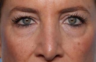 Blepharoplasty Before & After Patient #33674