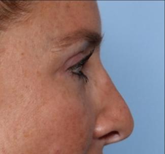 Blepharoplasty Before & After Patient #33674