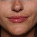 Lip Filler Before & After Patient #33685