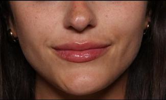 Lip Filler Before & After Patient #33685